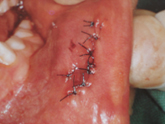 area-sutured