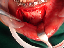 radiograph_showing_fracture_of_jaw