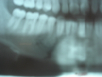 radiograph_showing_fracture_of_jaw