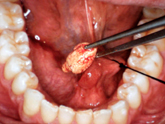 suturing_of_hole